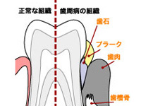 歯周病の原因は何？